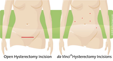 incision-comparison-hyst07-05-1